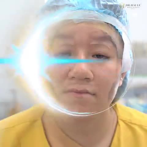 LẤY LẠI ĐÔI MẮT TINH ANH, SỰ TỰ TIN SAU KHI CHỈNH SỤP MÍ BẨM SINH TẠI DR.HẢI LÊ